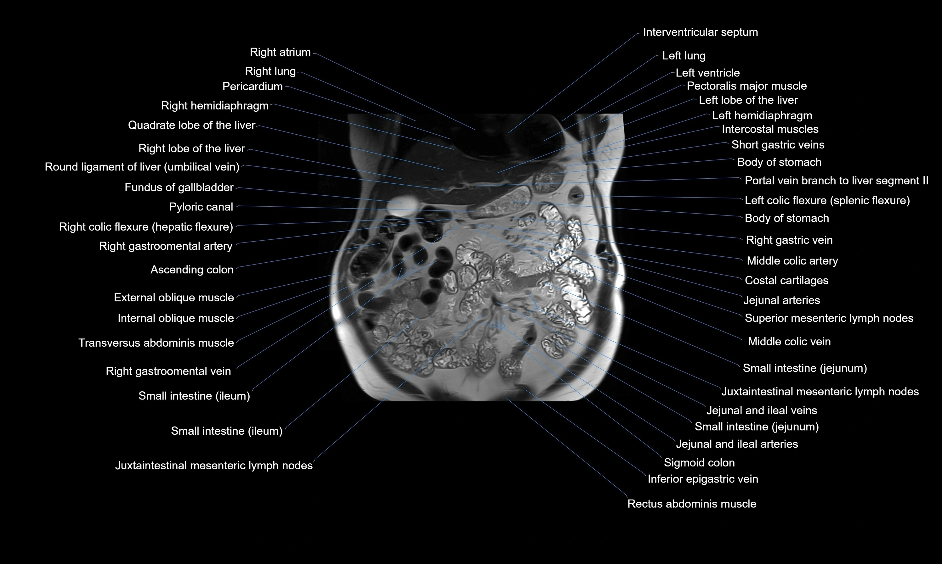 MRI Abdomen axial cross sectional anatomy radiology  image-img-00001-00019.webp